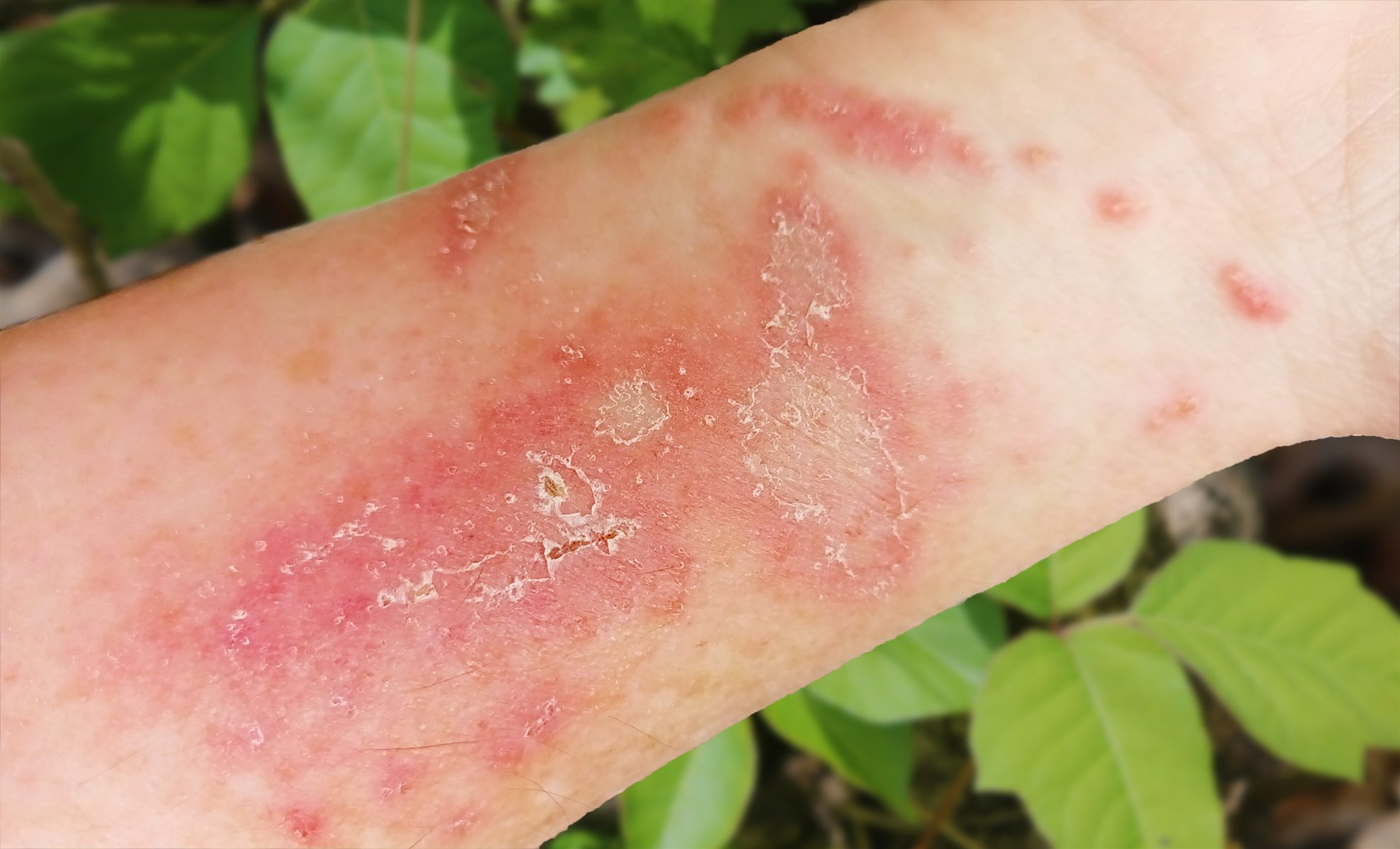 poison-ivy-rash